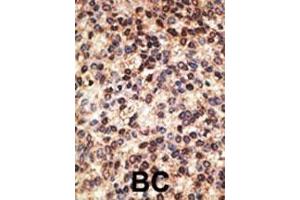 Formalin-fixed and paraffin-embedded human cancer tissue reacted with the primary antibody, which was peroxidase-conjugated to the secondary antibody, followed by DAB staining. (JAG2 antibody  (C-Term))