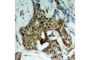 Immunohistochemical analysis of STAT1 (pY701) staining in human breast cancer formalin fixed paraffin embedded tissue section.