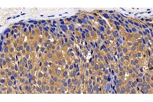 Detection of CTSK in Human Breast cancer Tissue using Polyclonal Antibody to Cathepsin K (CTSK) (Cathepsin K antibody  (AA 54-317))