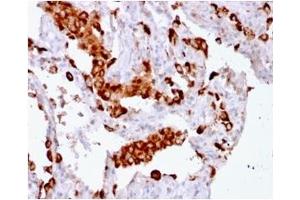 Formalin-fixed, paraffin-embedded human Lung Adenocarcinoma stained with Napsin A Mouse Recombinant Monoclonal Antibody (rNAPSA/1239). (Recombinant NAPSA antibody  (AA 189-299))