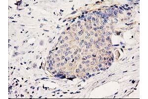 Immunohistochemical staining of paraffin-embedded Adenocarcinoma of Human breast tissue using anti-BCAR1 mouse monoclonal antibody. (BCAR1 antibody)
