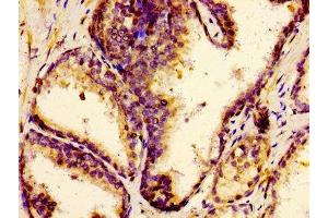 Immunohistochemistry of paraffin-embedded human prostate cancer using ABIN7147997 at dilution of 1:100 (F12 antibody  (AA 486-600))