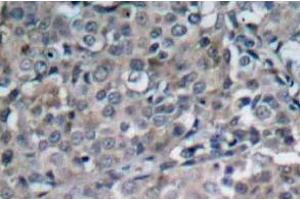 Immunohistochemistry (IHC) analyzes of FAK antibody in paraffin-embedded human breast carcinoma tissue. (FAK antibody)
