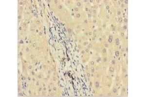 Immunohistochemistry of paraffin-embedded human liver cancer using ABIN7165631 at dilution of 1:100 (C11orf73 antibody  (AA 1-197))