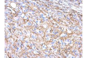 IHC-P Image Immunohistochemical analysis of paraffin-embedded U373 xenograft, using beta Actin, antibody at 1:500 dilution. (beta Actin antibody  (N-Term))