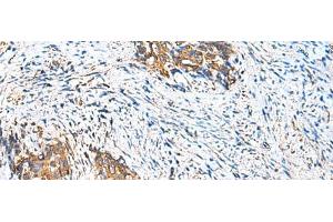 Immunohistochemistry of paraffin-embedded Human cervical cancer tissue using CAMSAP3 Polyclonal Antibody at dilution of 1:110(x200) (CAMSAP3 antibody)