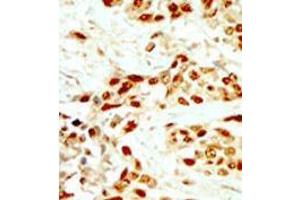 Formalin-fixed and paraffin-embedded human cancer tissue (breast carcinoma) reacted with the primary antibody, which was peroxidase-conjugated to the secondary antibody, followed by DAB staining. (DAPK2 antibody  (N-Term))