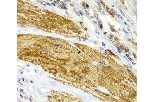 Immunohistochemistry of paraffin-embedded Human gastric cancer using CDK6 Polyclonal Antibody at dilution of 1:100 (40x lens). (CDK6 antibody)