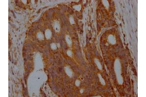 IHC image of ABIN7127334 diluted at 1:100 and staining in paraffin-embedded human colon cancer performed on a Leica BondTM system. (Recombinant ALDOA antibody)