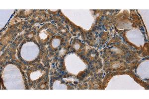 Immunohistochemistry of paraffin-embedded Human thyroid cancer using SCGB2A1 Polyclonal Antibody at dilution of 1:50