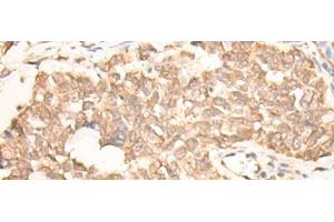 Immunohistochemistry of paraffin-embedded Human lung cancer tissue using EMSY Polyclonal Antibody at dilution of 1:25(x200) (EMSY antibody)