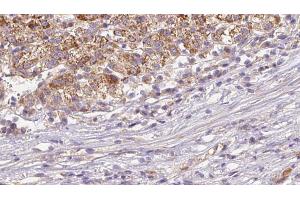 ABIN6272645 at 1/100 staining Human liver cancer tissue by IHC-P. (CD235a/GYPA antibody  (Internal Region))