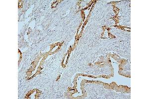 IHC analysis of MMP1 using anti-MMP1 antibody (ABIN7599873). (MMP1 antibody  (AA 124-469))