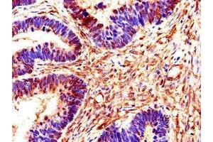 Immunohistochemistry of paraffin-embedded human ovarian cancer using ABIN7170549 at dilution of 1:100 (SMS antibody  (AA 16-191))