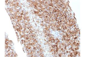 Formalin-fixed, paraffin-embedded human Melanoma stained with CD63 Mouse Monoclonal Antibody (LAMP3/2881) (CD63 antibody  (AA 100-197))