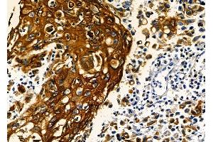 ABIN6262729 and ABIN6278925 at 1/100 staining human esophageal cancer by IHC-P. (Keratin 6 antibody  (C-Term))