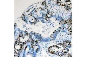 Immunohistochemical analysis of PIAS1 staining in human colon cancer formalin fixed paraffin embedded tissue section.
