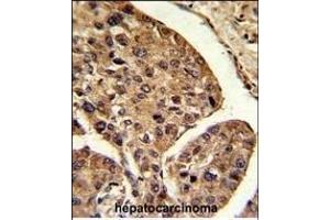 Formalin-fixed and paraffin-embedded mouse hepatocarcinoma reacted with PSME2 Antibody (Center), which was peroxidase-conjugated to the secondary antibody, followed by DAB staining. (PSME2 antibody  (AA 61-91))