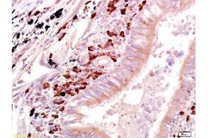 Formalin-fixed and paraffin embedded human lung carcinoma labeled with Anti-OAS1 Polyclonal Antibody, Unconjugated (ABIN671931) at 1:200 followed by conjugation to the secondary antibody and DAB staining (OAS1 antibody)
