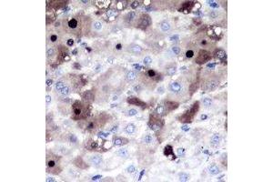 Immunohistochemical analysis of PSMD8 staining in human liver cancer formalin fixed paraffin embedded tissue section. (PSMD8 antibody)
