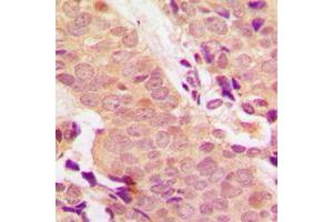 Immunohistochemical analysis of STAT5 (pY694/699) staining in human breast cancer formalin fixed paraffin embedded tissue section.