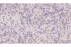 ABIN6273121 at 1/100 staining Human lymph cancer tissue by IHC-P.