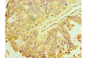 Immunohistochemistry of paraffin-embedded human endometrial cancer using ABIN7150706 at dilution of 1:100 (MAP2K3 antibody  (AA 1-170))