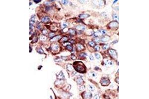 Formalin-fixed and paraffin-embedded human cancer tissue reacted with the primary antibody, which was peroxidase-conjugated to the secondary antibody, followed by DAB staining. (AXL antibody  (C-Term))
