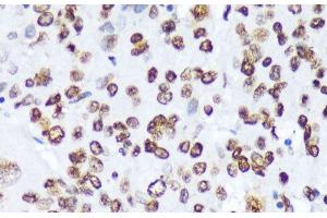 Immunohistochemistry of paraffin-embedded Human liver cancer using Phospho-ABL1(Y245) Polyclonal Antibody at dilution of 1:100 (40x lens). (ABL1 antibody  (pTyr245))