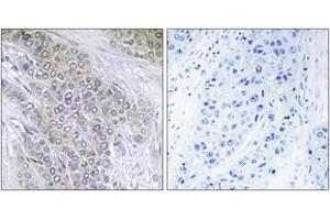Immunohistochemistry analysis of paraffin-embedded human breast carcinoma, using BCL-2 (Phospho-Thr56) Antibody.