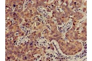 Immunohistochemistry of paraffin-embedded human pancreatic cancer using ABIN7149950 at dilution of 1:100 (TFB2M antibody  (AA 30-108))