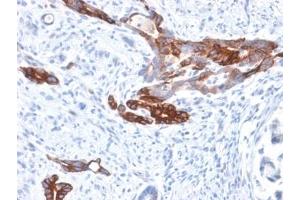 IHC staining of FFPE human gastric carcinoma with recombinant Gastric Mucin antibody (clone MUC6/1553R). (MUC6 antibody)