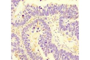 Immunohistochemistry of paraffin-embedded human ovarian cancer using ABIN7170745 at dilution of 1:100 (SAMD7 antibody  (AA 1-300))