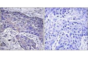 Immunohistochemistry analysis of paraffin-embedded human lung carcinoma tissue, using POFUT1 Antibody. (POFUT1 antibody  (AA 331-380))