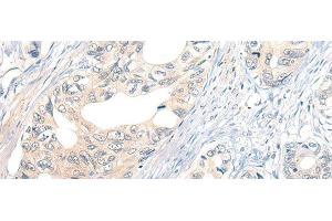Immunohistochemistry of paraffin-embedded Human gastric cancer tissue using NOG Polyclonal Antibody at dilution of 1:50(x200) (NOG antibody)