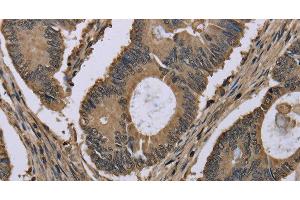 Immunohistochemistry of paraffin-embedded Human colon cancer tissue using MYO18B Polyclonal Antibody at dilution 1:50 (MYO18B antibody)