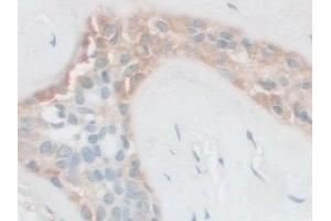 Detection of FSTL1 in Human Breast cancer Tissue using Polyclonal Antibody to Follistatin Like Protein 1 (FSTL1) (FSTL1 antibody  (AA 21-308))