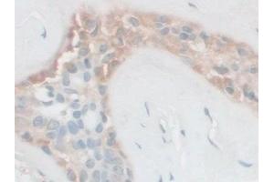 Detection of FSTL1 in Human Breast cancer Tissue using Polyclonal Antibody to Follistatin Like Protein 1 (FSTL1)