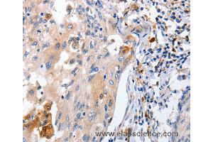 Immunohistochemistry of Human cervical cancer using IL18 Polyclonal Antibody at dilution of 1:100