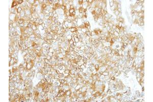 IHC-P Image Immunohistochemical analysis of paraffin-embedded BT474 xenograft, using Calpain 1, antibody at 1:500 dilution. (CAPN1 antibody)