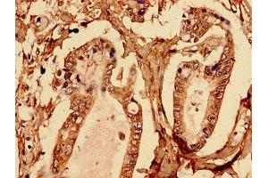 Immunohistochemistry analysis of human pancreatic cancer using ABIN7145580 at dilution of 1:100 (Biglycan antibody  (AA 38-300))