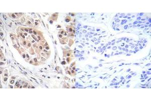 Immunohistochemical analysis of paraffin-embedded human breast carcinoma tissue using FOXO3A (phospho- Ser253) antibody (E012020). (FOXO3 antibody  (pSer253))
