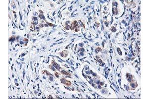 Immunohistochemical staining of paraffin-embedded Carcinoma of Human lung tissue using anti-HARS2 mouse monoclonal antibody.