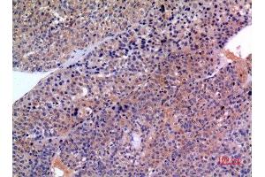 Immunohistochemistry (IHC) analysis of paraffin-embedded Human Liver Cancer, antibody was diluted at 1:100. (SCCA1/2 (Internal Region) antibody)