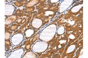 The image on the left is immunohistochemistry of paraffin-embedded Human thyroid cancer tissue using ABIN7131182(SRGAP3 Antibody) at dilution 1/40, on the right is treated with fusion protein. (SRGAP3 antibody)