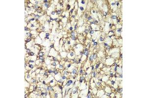 Immunohistochemistry of paraffin-embedded human kidney cancer using PTGES2 antibody. (PTGES2 antibody  (AA 88-377))