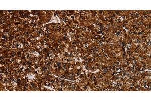 Immunohistochemistry of paraffin-embedded Human prostate cancer tissue using NDUFAB1 Polyclonal Antibody at dilution 1:50 (NDUFAB1 antibody)