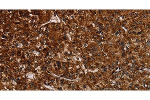 Immunohistochemistry of paraffin-embedded Human prostate cancer tissue using NDUFAB1 Polyclonal Antibody at dilution 1:50