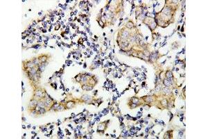 IHC-P: Caspase-8 antibody testing of human breast cancer tissue (Caspase 8 antibody  (AA 458-473))