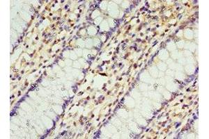 Immunohistochemistry of paraffin-embedded human colon cancer using ABIN7168957 at dilution of 1:100 (STRAP antibody  (AA 1-350))